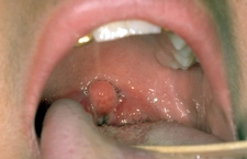 Boğaz Enfeksiyonu Belirtileri