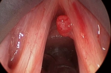 Ses Telleri Özellikleri ve Hastalıkları